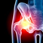 Hip in pain x-ray